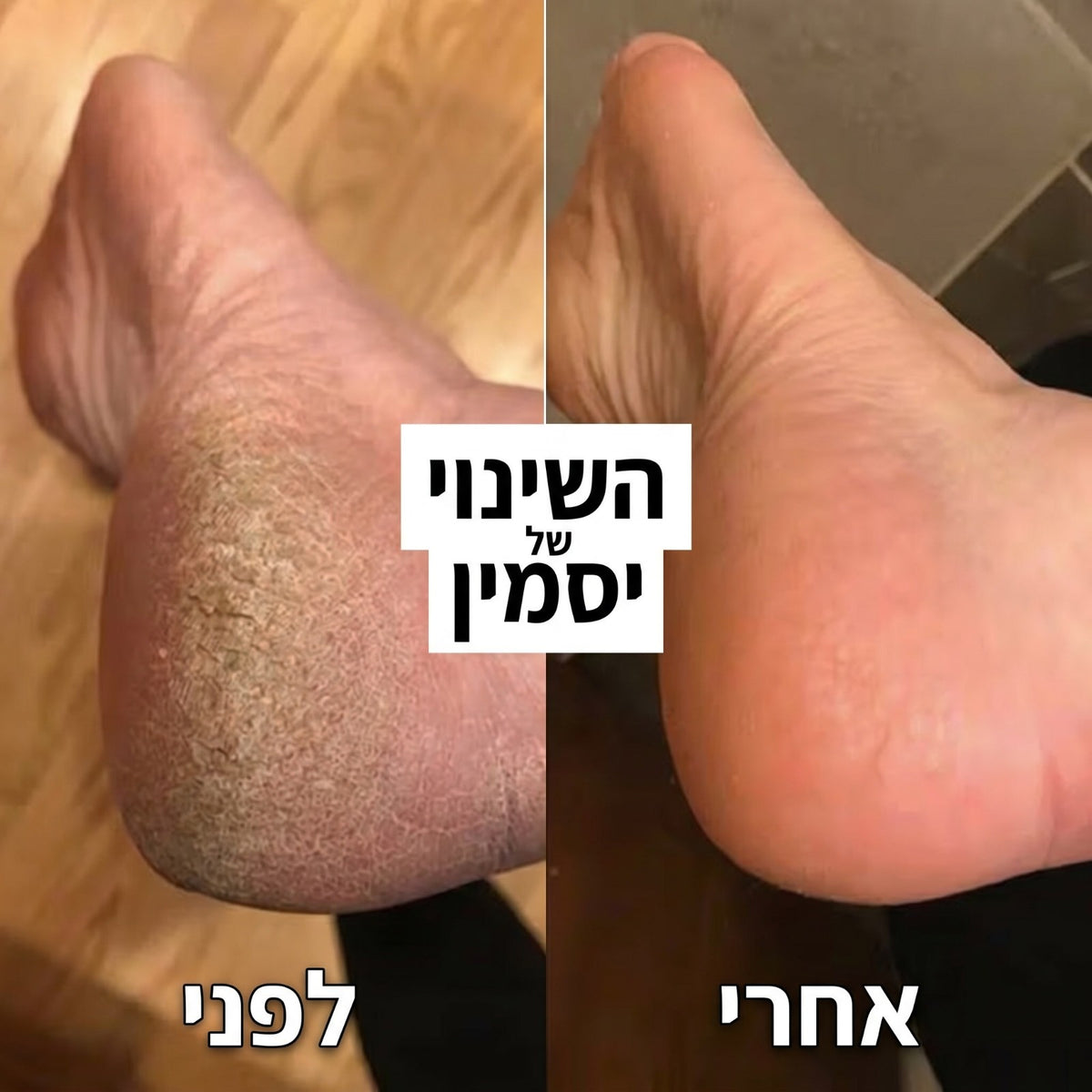 ™SoleCare Pro - מכשיר פדיקור להסרת עור יבש בכפות הרגליים