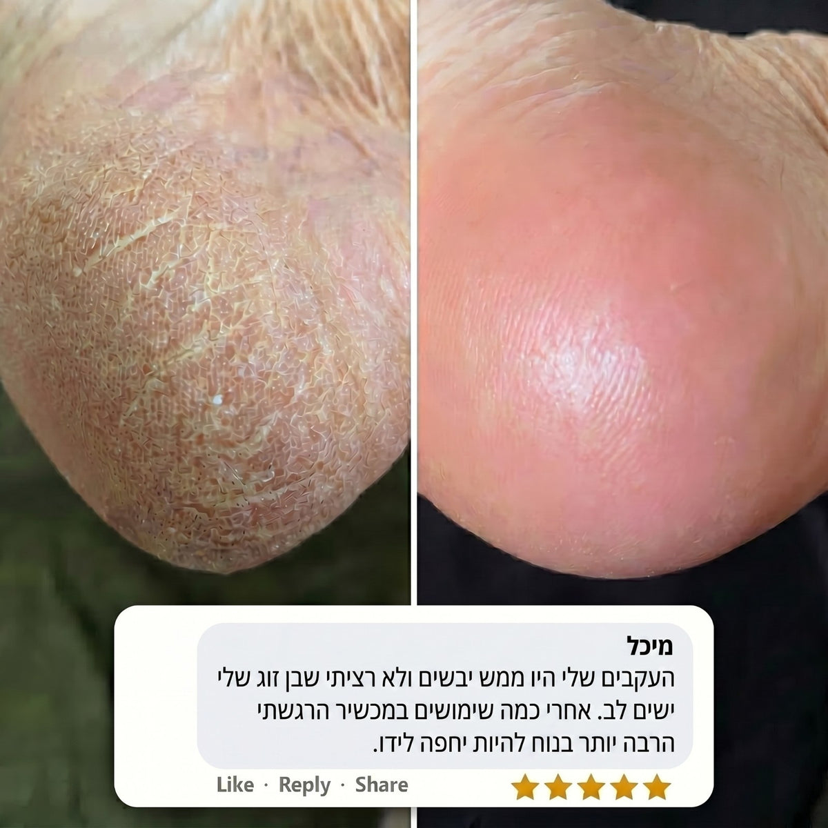™SoleCare Pro - מכשיר פדיקור להסרת עור יבש בכפות הרגליים